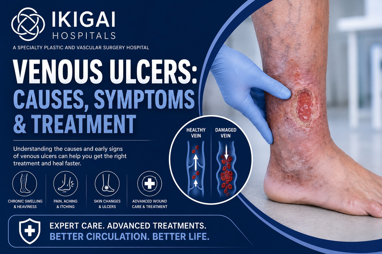 Venous Ulcers: Causes, Symptoms & Treatment